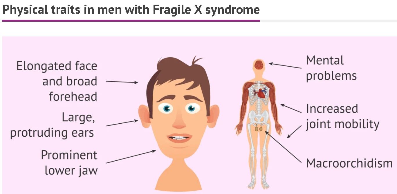 Fragile X syndrome clinical signs in men