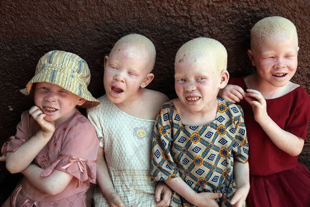 Albinism in Humans