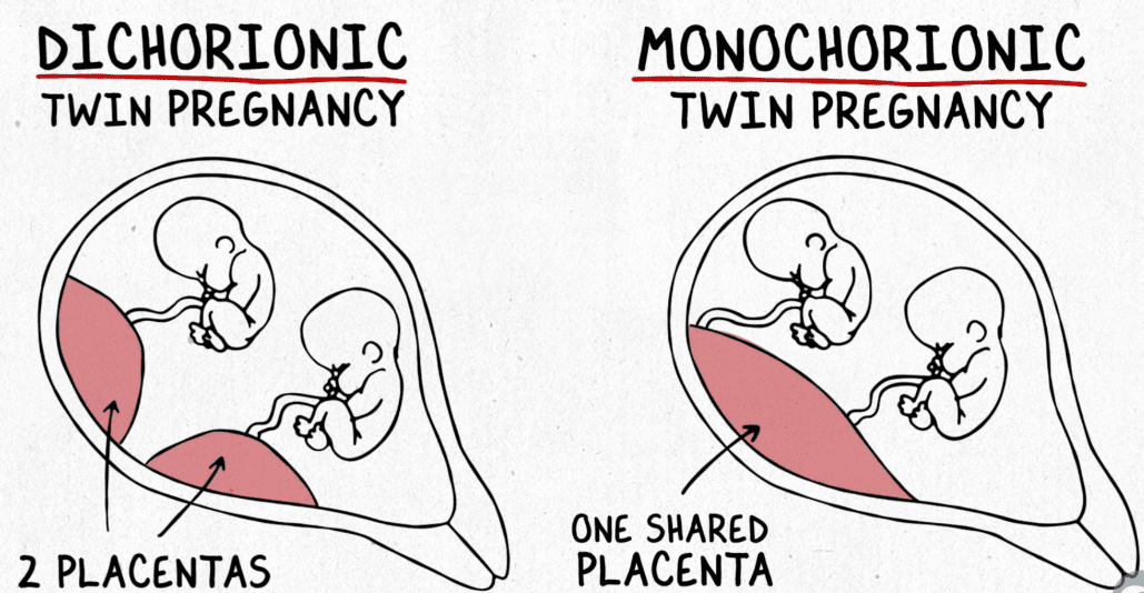 Monochorionic and dichorionic setups